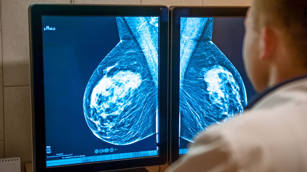 prevención-mamografía-tipos-cáncer-de-mama